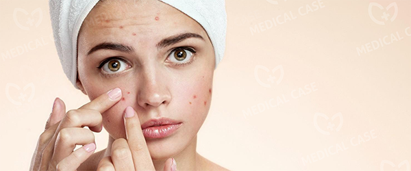 лечения акне 1